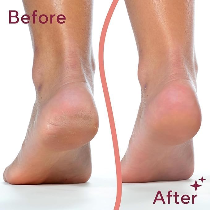 Flawless Pedi™ Electric Foot File & Callus Remover